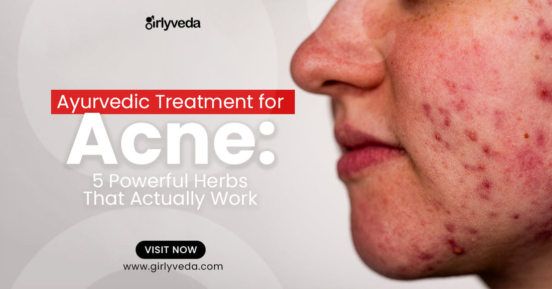 Ayurvedic Treatment For Acne