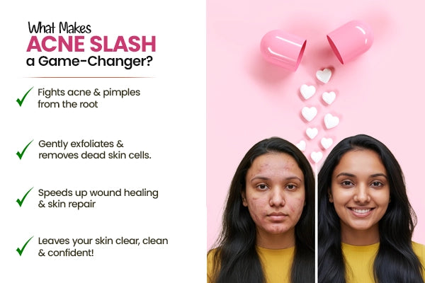 Acne Capsule: Ayurvedic Acne Relief Capsules for Women