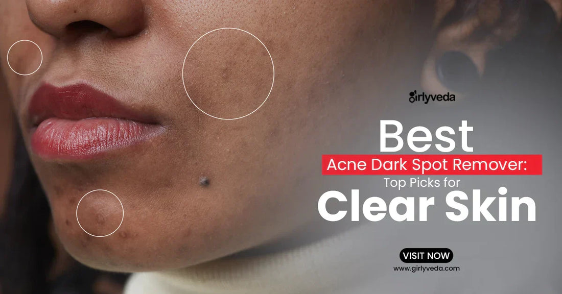 Best Acne Dark Spot Remover tips